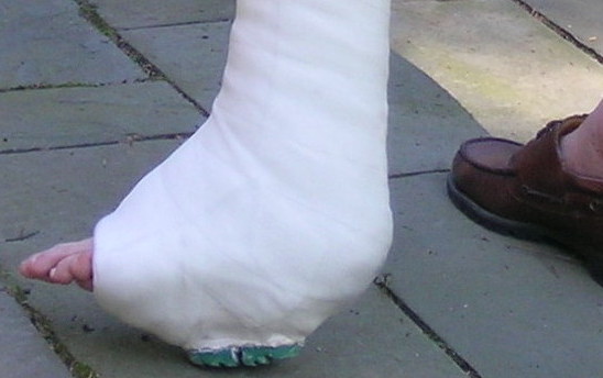 A foot in a cast